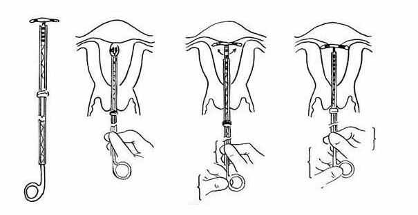 上环避孕原理图解图片